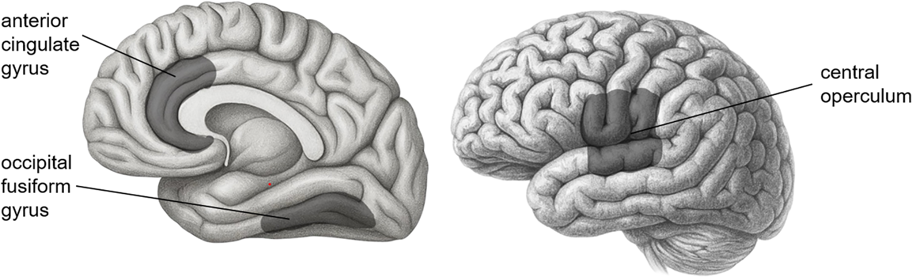 Three brain areas significantly mediated between genes and PTSD symptom severity.
